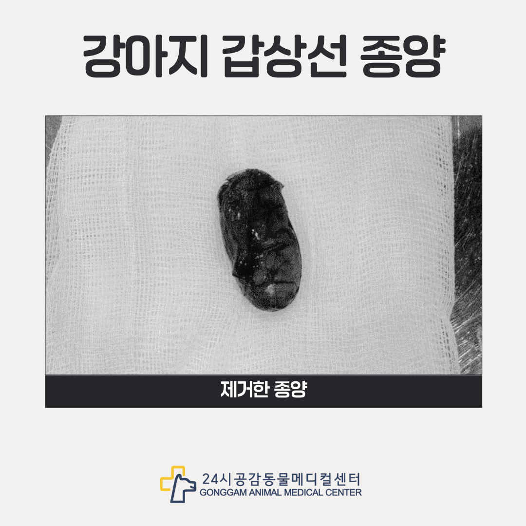 수술로 절제한 갑상선 종양
