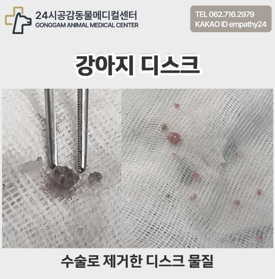 수술로 제거한 디스크